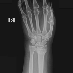 Gãy Pouteau - Colles