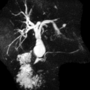 Nang ống mật chủ